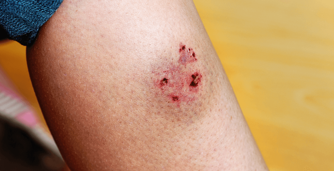 Dog bite injury first aid steps - akd law 